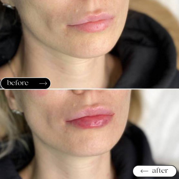 Збільшення губ
                    Косметологический центр Safe Cosmo Kyiv Киев