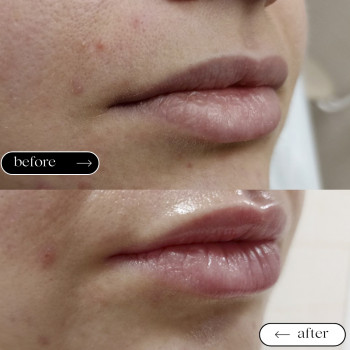 Збільшення губ
                    Косметологический центр Safe Cosmo Kyiv Киев