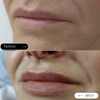 Збільшення губ
                    Косметологический центр Safe Cosmo Kyiv Киев