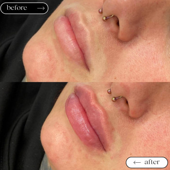 Збільшення губ
                    Косметологический центр Safe Cosmo Kyiv Киев