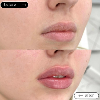 Збільшення губ
                    Косметологический центр Safe Cosmo Kyiv Киев