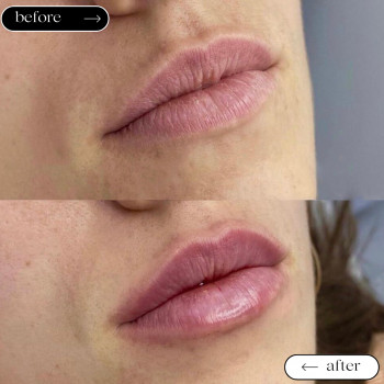 Збільшення губ
                    Косметологический центр Safe Cosmo Kyiv Киев