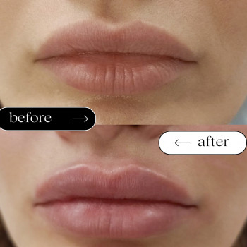 Збільшення губ
                    Косметологический центр Safe Cosmo Kyiv Киев