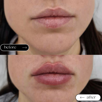 Збільшення губ
                    Косметологический центр Safe Cosmo Kyiv Киев