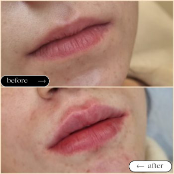 Відновлення втраченого об'єму губ
                    Косметологический центр Safe Cosmo Kyiv Киев