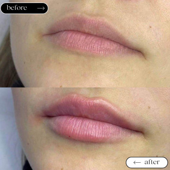 Відновлення втраченого об'єму губ
                    Косметологический центр Safe Cosmo Kyiv Киев