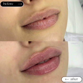 Відновлення втраченого об'єму губ
                    Косметологический центр Safe Cosmo Kyiv Киев