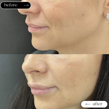 Відновлення втраченого об'єму губ
                    Косметологический центр Safe Cosmo Kyiv Киев