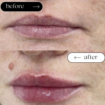 Відновлення втраченого об'єму губ
                    Косметологический центр Safe Cosmo Kyiv Киев