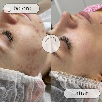 ACNE STOP
                    Косметологічний центр Safe Cosmo Kyiv Київ