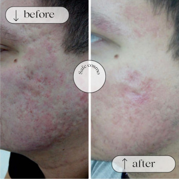 ACNE STOP
                    Косметологічний центр Safe Cosmo Kyiv Київ
