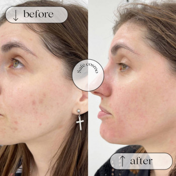 ACNE STOP
                    Косметологічний центр Safe Cosmo Kyiv Київ