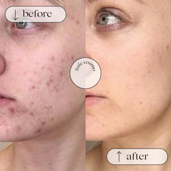 ACNE STOP
                    Косметологічний центр Safe Cosmo Kyiv Київ
