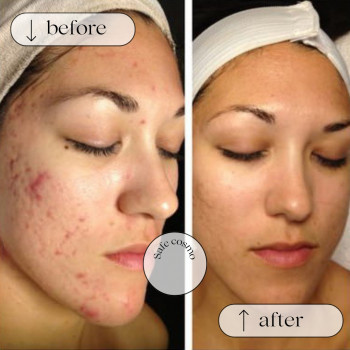 ACNE STOP
                    Косметологічний центр Safe Cosmo Kyiv Київ