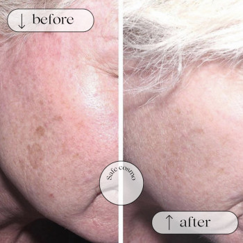 Меланопіл
                    Косметологічний центр Safe Cosmo Kyiv Київ