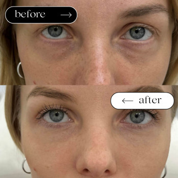 Мезо Очі (від мішків, темних кіл)
                    Косметологический центр Safe Cosmo Kyiv Киев