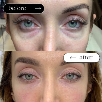 Мезо Очі (від мішків, темних кіл)
                    Косметологический центр Safe Cosmo Kyiv Киев