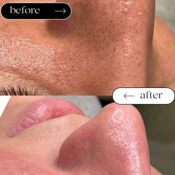 Чистка Механічна
                    Косметологический центр Safe Cosmo Kyiv Киев