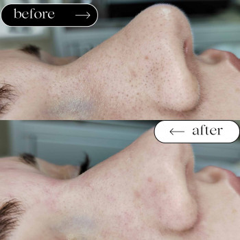 Чистка Механічна
                    Косметологический центр Safe Cosmo Kyiv Киев