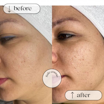 Чистка Механічна
                    Косметологический центр Safe Cosmo Kyiv Киев