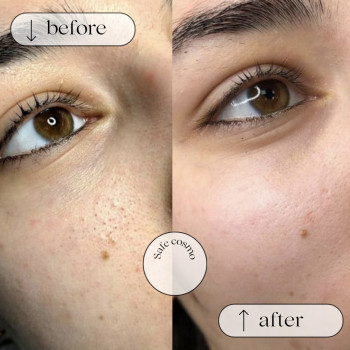 Чистка Механічна
                    Косметологический центр Safe Cosmo Kyiv Киев