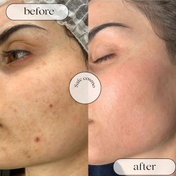 Чистка Механічна
                    Косметологический центр Safe Cosmo Kyiv Киев