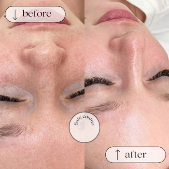 Чистка Ультразвукова
                    Косметологический центр Safe Cosmo Kyiv Киев