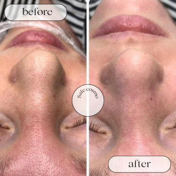 Чистка Ультразвукова
                    Косметологический центр Safe Cosmo Kyiv Киев