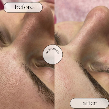 Чистка Ультразвукова
                    Косметологический центр Safe Cosmo Kyiv Киев