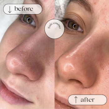 Чистка Ультразвукова
                    Косметологический центр Safe Cosmo Kyiv Киев