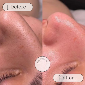 Чистка Ультразвукова
                    Косметологический центр Safe Cosmo Kyiv Киев