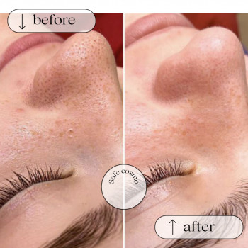 Чистка Комбінована
                    Косметологический центр Safe Cosmo Kyiv Киев