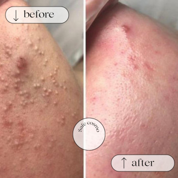 Чистка Комбінована
                    Косметологический центр Safe Cosmo Kyiv Киев