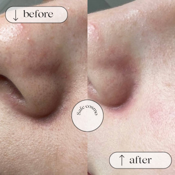 Чистка Комбінована
                    Косметологический центр Safe Cosmo Kyiv Киев