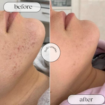 Чистка Комбінована
                    Косметологический центр Safe Cosmo Kyiv Киев