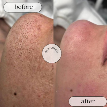 Чистка Комбінована
                    Косметологический центр Safe Cosmo Kyiv Киев