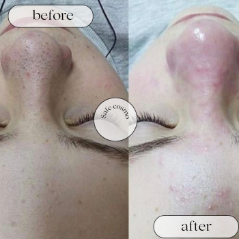 Чистка Комбінована
                    Косметологический центр Safe Cosmo Kyiv Киев