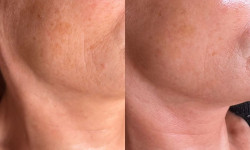 Плазмотерапія PRF новий стандарт Врач-косметолог Юлія Луцк