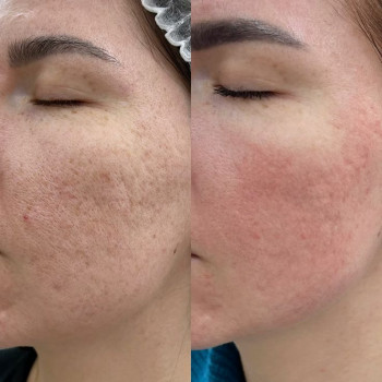 Плазмотерапія PPP новий спосіб омолодження
                    Лікар-косметолог Юлія Луцьк