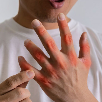 Крапельниця ЗОЛЕУМ при ОСТЕОПАРОЗІ (для жінок та чоловіків)
                    Врач-косметолог Юлія Луцк