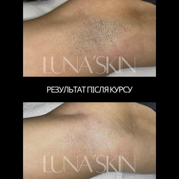 лазерна епіляція, лазерна епіляція бікіні