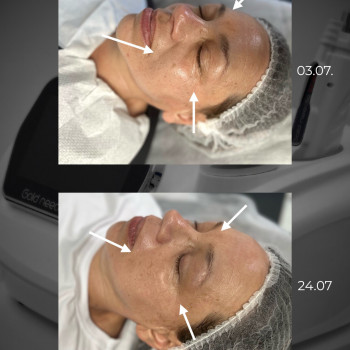 микроигольчатый rf лифтинг