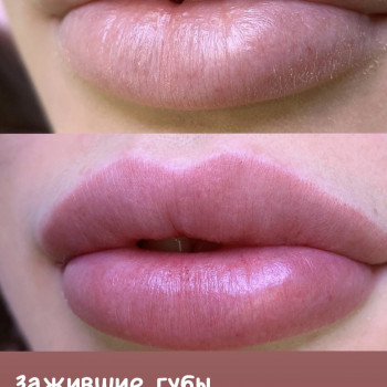 Зажившие 💫