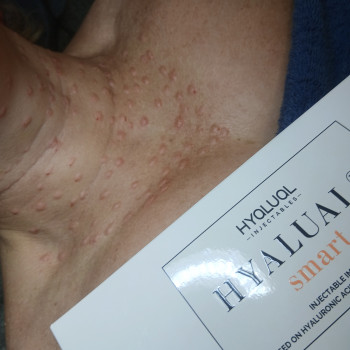 Редермалізація препаратами Hyalual
   
 