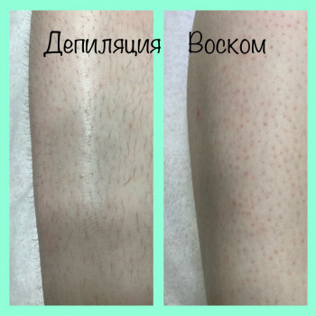 Депіляція гомілок воском