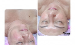 Ферментотерапия Косметолог-ін'єкціоніст Юлия Кропивницький