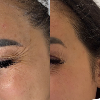 Фото из портфолио косметолога Олена Поліщук (Одесса)