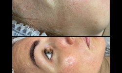 Пілінг PRX t33 Косметологічний центр Perfect Skin Київ