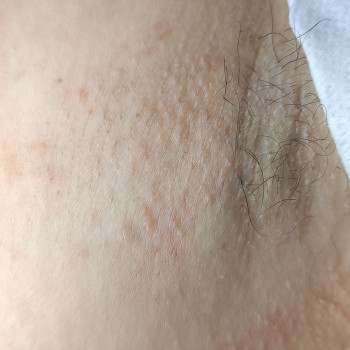 Электроэпиляция
                    Электролог Катя Харьков