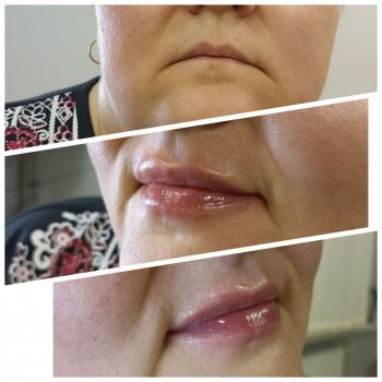 Делікатна корекція губ.